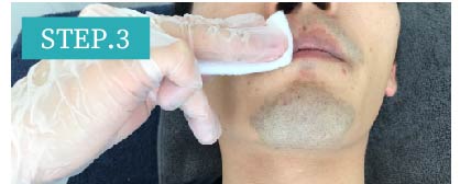 あごひげ脱毛Step3