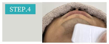 鼻下ヒゲ脱毛Step4