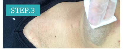 ほほヒゲ脱毛Step3
