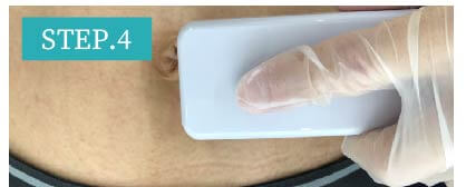 腹毛脱毛Step4