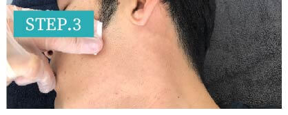 ワキ脱毛Step3