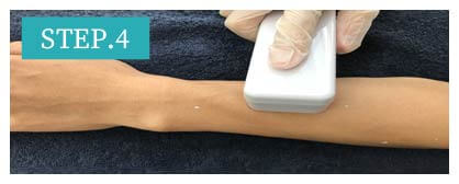 ワキ脱毛Step4